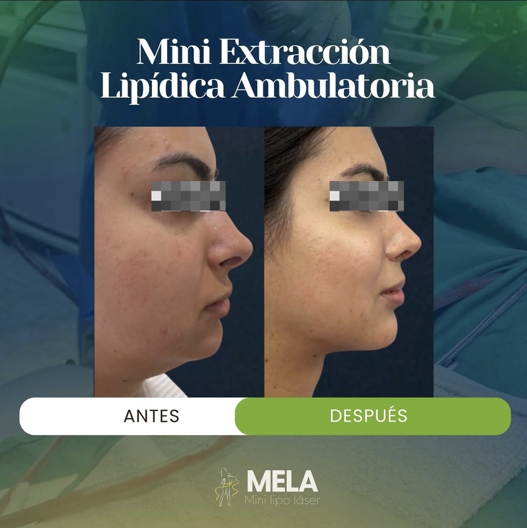 Antes y después de tratamiento estético